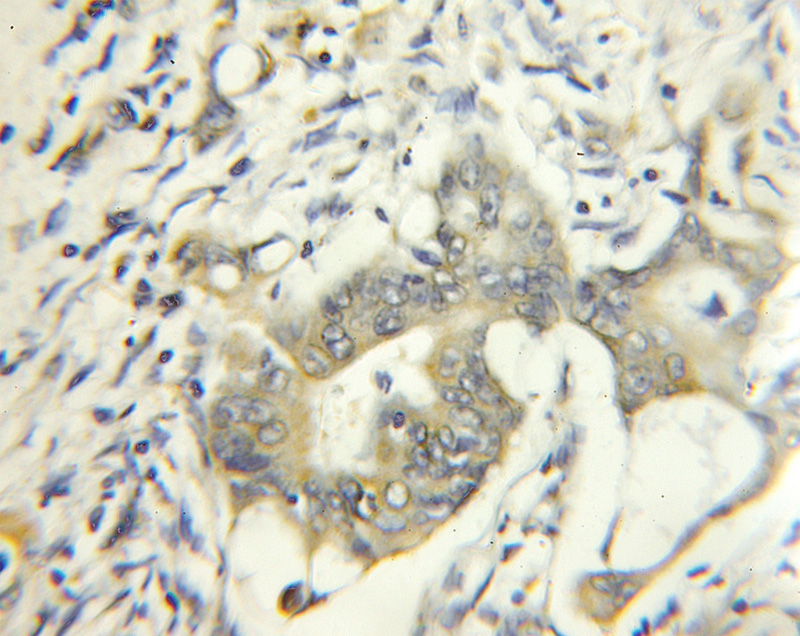 Immunohistochemical of paraffin-embedded human colon cancer using Catalog No:108553(BUB1B antibody) at dilution of 1:10 (under 10x lens)