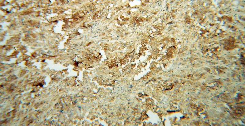 Immunohistochemical of paraffin-embedded human prostate cancer using Catalog No:107709(ACTL7B antibody) at dilution of 1:100 (under 10x lens)