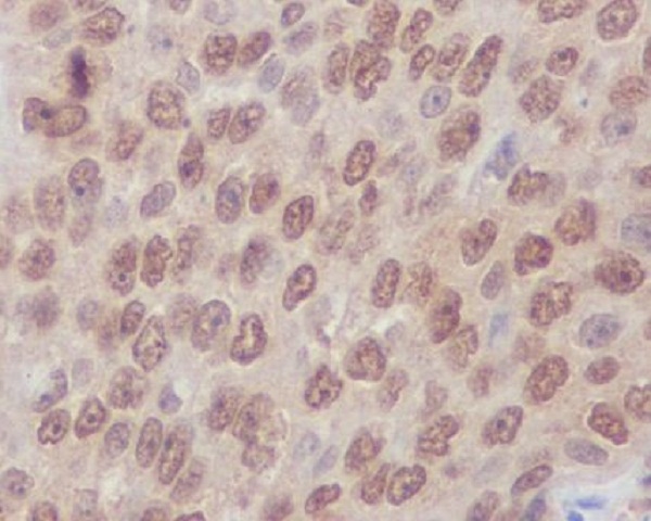 Immunohistochemical analysis of paraffin-embedded human lung carcinoma, using Rho A + B + C Antibody .