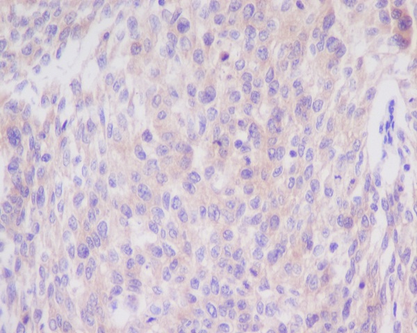 Immunohistochemical analysis of paraffin-embedded human cervix cancer, using Bim Antibody.