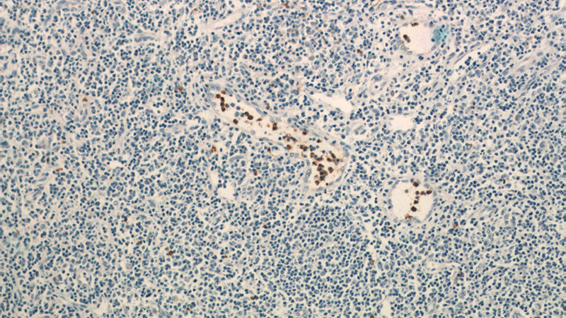 Immunohistochemistry of paraffin-embedded human tonsillitis tissue slide using Catalog No:113316(NCF2 Antibody) at dilution of 1:50(under 10x lens)