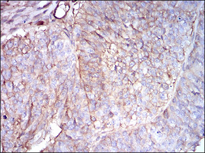 Immunohistochemical analysis of paraffin-embedded ovarian cancer tissues using B2M mouse mAb with DAB staining.