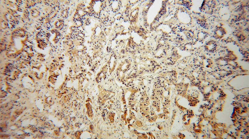 Immunohistochemical of paraffin-embedded human gliomas using Catalog No:113976(PNMA1 antibody) at dilution of 1:100 (under 10x lens)