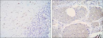 Immunohistochemical analysis of paraffin-embedded cerebellum tissues (left) and lung cancer (right) using ALDH1A1 mouse mAb with DAB staining.