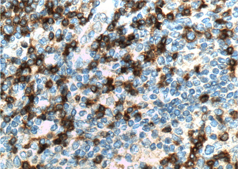 Immunohistochemistry of paraffin-embedded human tonsillitis tissue slide using Catalog No:109019(CD3D Antibody) at dilution of 1:200 (under 40x lens). heat mediated antigen retrieved with Tris-EDTA buffer(pH9).