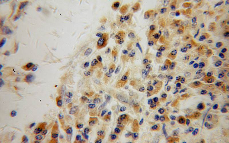 Immunohistochemical of paraffin-embedded human lung cancer using Catalog No:115230(SIK1 antibody) at dilution of 1:100 (under 40x lens)