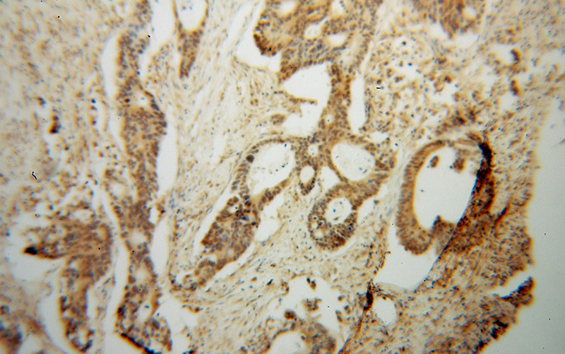 Immunohistochemical of paraffin-embedded human colon cancer using Catalog No:113670(PDE8A antibody) at dilution of 1:100 (under 10x lens)