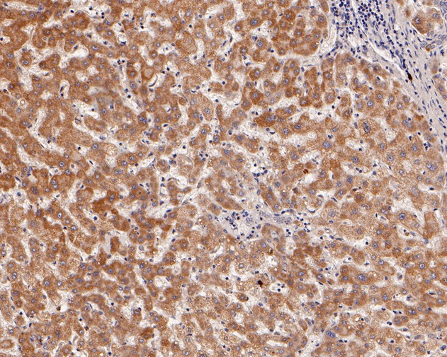 Fig3:; Immunohistochemical analysis of paraffin-embedded human liver tissue using anti-ACAA2 antibody. The section was pre-treated using heat mediated antigen retrieval with Tris-EDTA buffer (pH 8.0-8.4) for 20 minutes.The tissues were blocked in 5% BSA for 30 minutes at room temperature, washed with ddH; 2; O and PBS, and then probed with the primary antibody ( 1/200) for 30 minutes at room temperature. The detection was performed using an HRP conjugated compact polymer system. DAB was used as the chromogen. Tissues were counterstained with hematoxylin and mounted with DPX.