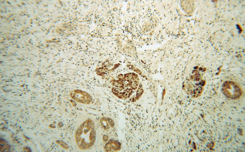 Immunohistochemical of paraffin-embedded human pancreas cancer using Catalog No:116902(ZADH2 antibody) at dilution of 1:50 (under 10x lens)