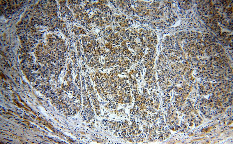 Immunohistochemical of paraffin-embedded human liver cancer using Catalog No:109984(DKK3 antibody) at dilution of 1:50 (under 10x lens)