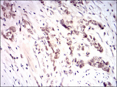 Immunohistochemical analysis of paraffin-embedded stomach cancer tissues using NFE2L2 mouse mAb with DAB staining.