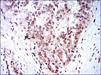 Immunohistochemical analysis of paraffin-embedded ovarian cancer tissues using SKP1 mouse mAb with DAB staining.