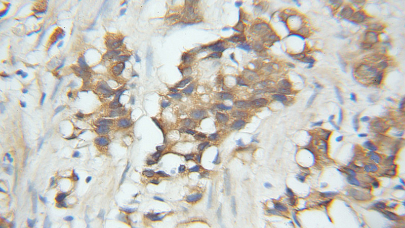 Immunohistochemical of paraffin-embedded human prostate cancer using Catalog No:115558(SPCS1 antibody) at dilution of 1:50 (under 10x lens)