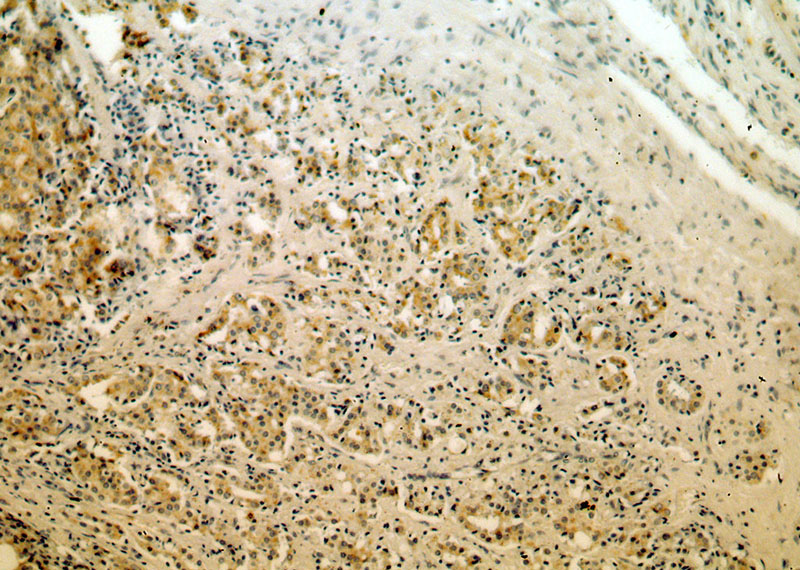 Immunohistochemical of paraffin-embedded human prostate cancer using Catalog No:112109(KLK3,PSA antibody) at dilution of 1:50 (under 10x lens)