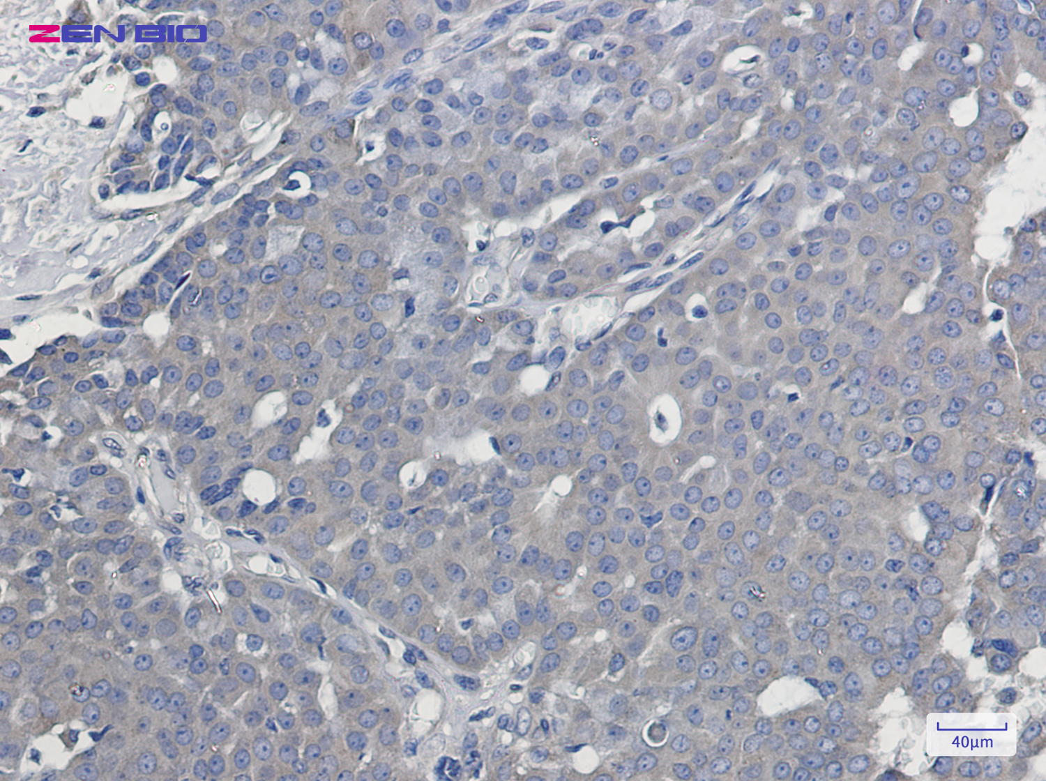 Immunohistochemistry of Syntrophin alpha 1 in paraffin-embedded Human breast cancer tissue using Syntrophin alpha 1 Rabbit pAb at dilution 1/50