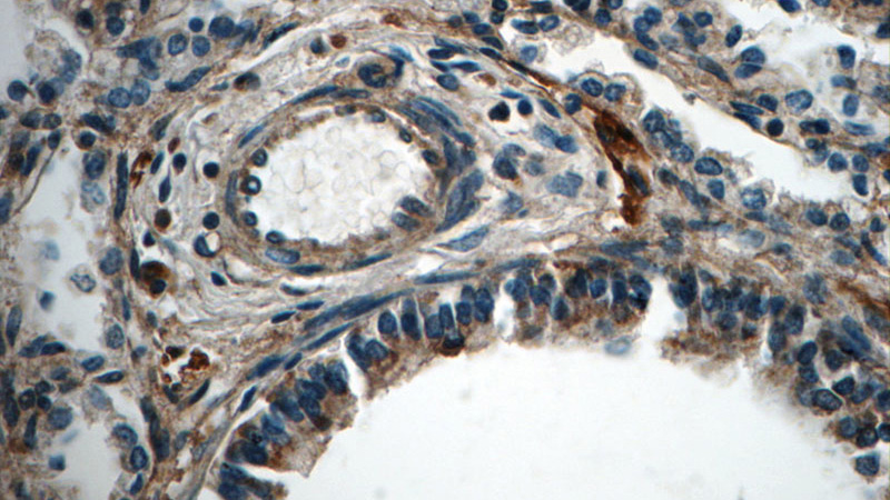 Immunohistochemistry of paraffin-embedded human lung tissue slide using Catalog No:113965(PLEKHO2 Antibody) at dilution of 1:50 (under 40x lens)