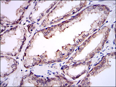 Immunohistochemical analysis of paraffin-embedded prostate tissues using UBE2I mouse mAb with DAB staining.