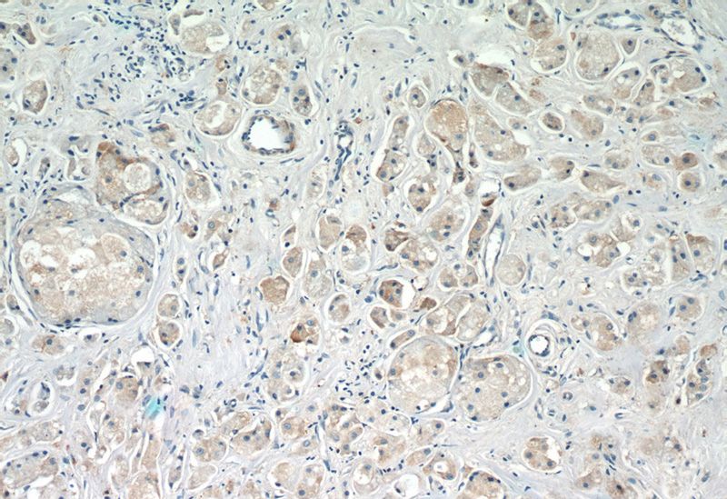 Immunohistochemistry of paraffin-embedded human breast cancer slide using Catalog No:108244(ARF3 Antibody) at dilution of 1:50 (under 10x lens)
