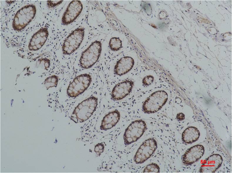 Immunohistochemical analysis of paraffin-embedded Human Colon Caricnoma using HSP90 alpha;  Mouse mAb diluted at 1:200.