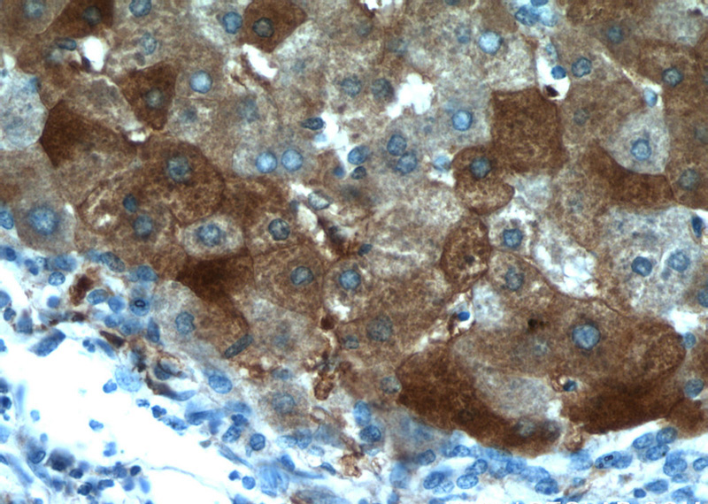 Immunohistochemical of paraffin-embedded human hepatocirrhosis using Catalog No:112361(LTBR antibody) at dilution of 1:50 (under 40x lens)