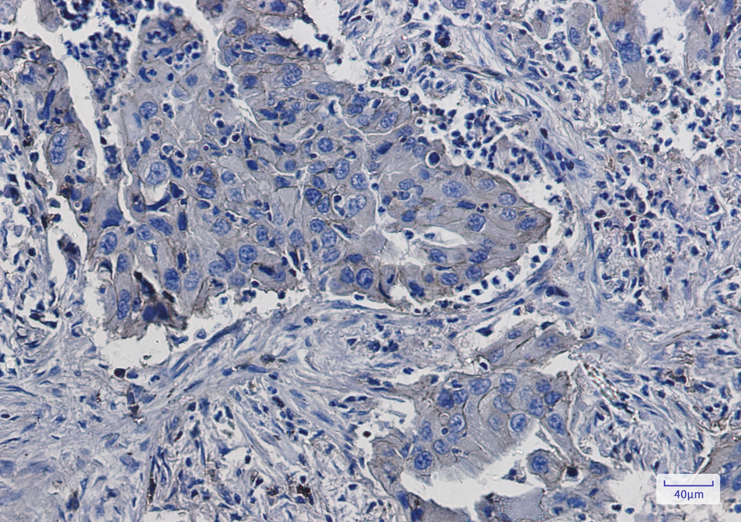 Immunohistochemistry of beta 2 Microglobulin in paraffin-embedded Human lung cancer tissue using beta 2 Microglobulin Rabbit pAb at dilution 1/50