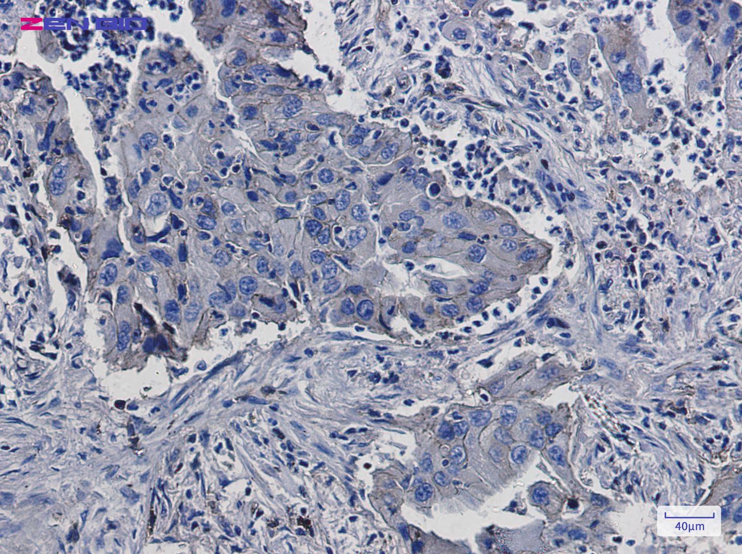 Immunohistochemistry of beta 2 Microglobulin in paraffin-embedded Human lung cancer tissue using beta 2 Microglobulin Rabbit pAb at dilution 1/50