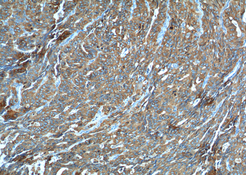 Immunohistochemistry of paraffin-embedded human ovary tumor tissue slide using Catalog No:111391(HE4 Antibody) at dilution of 1:100 (under 10x lens).