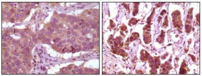 Immunohistochemical analysis of paraffin-embedded human lung carcinoma (left) and breast carcinoma (right) showing cytoplasmic localization using ERK2 mouse mAb with DAB staining.