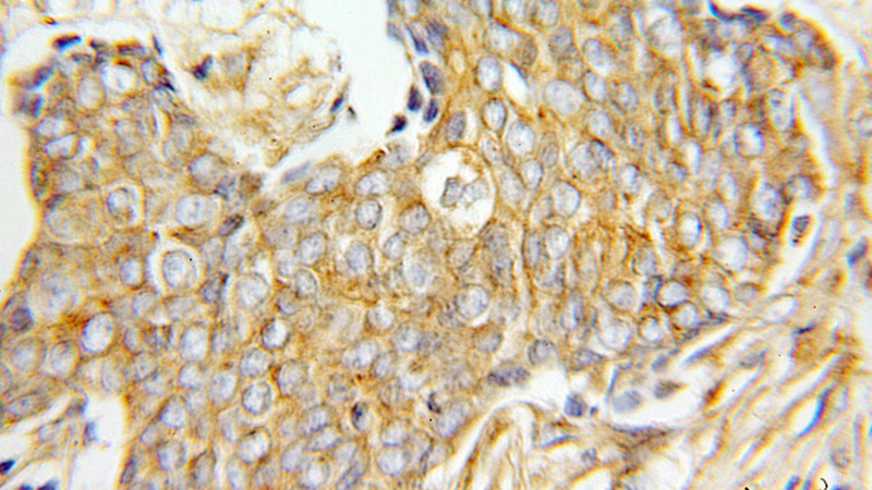Immunohistochemical of paraffin-embedded human breast cancer using Catalog No:109405(CLTA antibody) at dilution of 1:100 (under 10x lens)