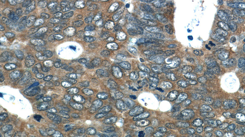 Immunohistochemistry of paraffin-embedded human colon cancer tissue slide using Catalog No:109103(CDC37 Antibody) at dilution of 1:50 (under 40x lens)