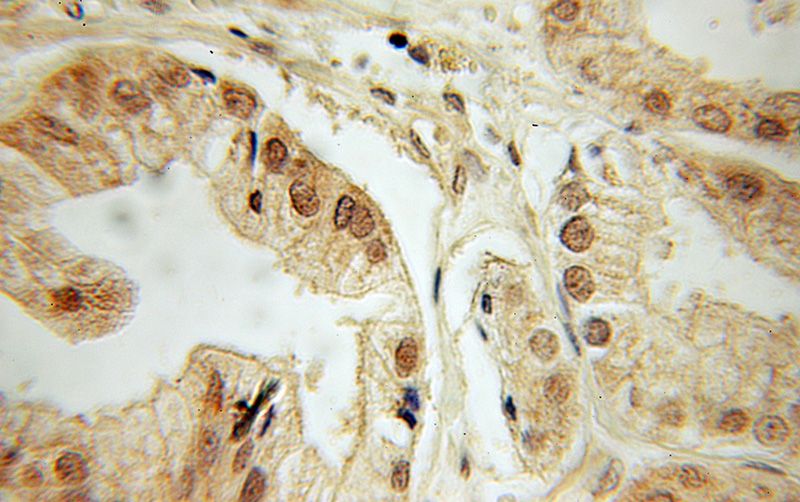 Immunohistochemical of paraffin-embedded human prostate cancer using Catalog No:109846(DEDD antibody) at dilution of 1:50 (under 10x lens)