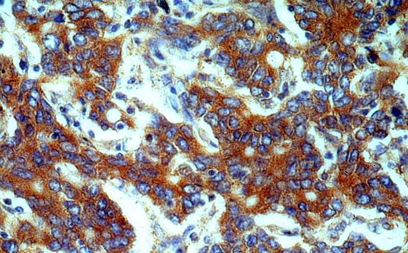 Immunohistochemical of paraffin-embedded human stomach cancer using Catalog No:110316(EEF2 antibody) at dilution of 1:100 (under 40x lens)