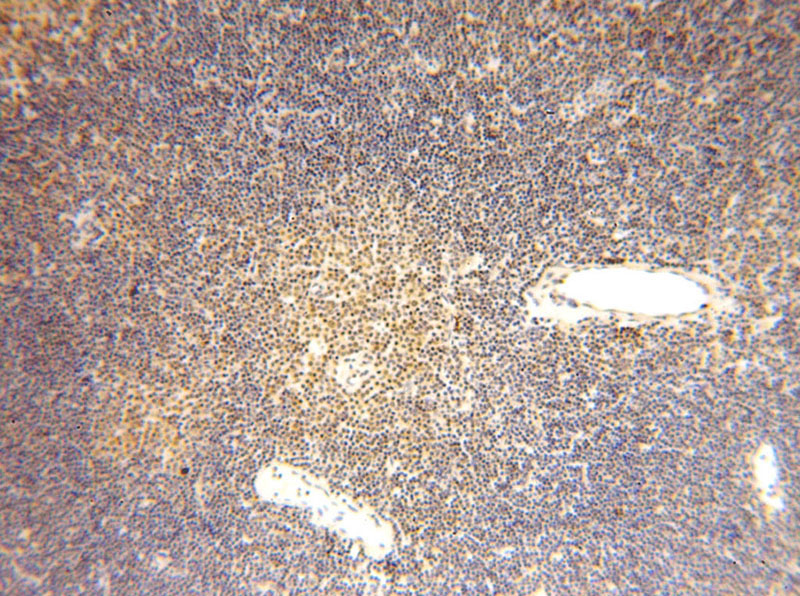 Immunohistochemical of paraffin-embedded human lymphoma using Catalog No:111096(GMDS antibody) at dilution of 1:50 (under 10x lens)