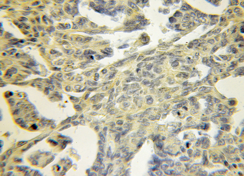 Immunohistochemical of paraffin-embedded human ovary tumor using Catalog No:116206(TPM3 antibody) at dilution of 1:50 (under 10x lens)