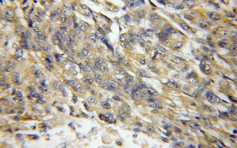 Immunohistochemical of paraffin-embedded human lung cancer using Catalog No:111548(HSD17B6 antibody) at dilution of 1:50 (under 10x lens)