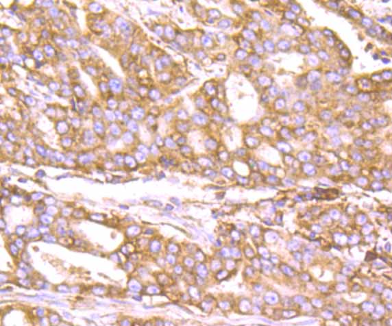 Fig6:; Immunohistochemical analysis of paraffin-embedded human stomach carcinoma tissue using anti-KDEL antibody. The section was pre-treated using heat mediated antigen retrieval with Tris-EDTA buffer (pH 8.0-8.4) for 20 minutes.The tissues were blocked in 5% BSA for 30 minutes at room temperature, washed with ddH; 2; O and PBS, and then probed with the primary antibody ( 1/50) for 30 minutes at room temperature. The detection was performed using an HRP conjugated compact polymer system. DAB was used as the chromogen. Tissues were counterstained with hematoxylin and mounted with DPX.