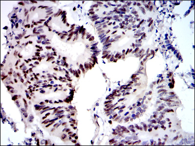 Immunohistochemical analysis of paraffin-embedded colon cancer tissues using MCM2 mouse mAb with DAB staining.