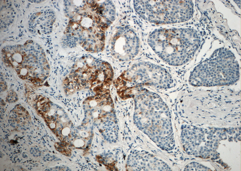 Immunohistochemistry of paraffin-embedded human lung cancer slide using Catalog No:112242(LIPC Antibody) at dilution of 1:50