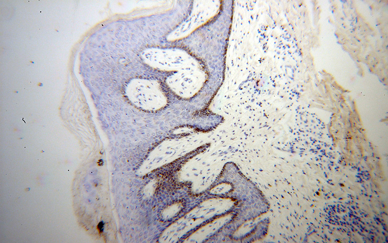 Immunohistochemical of paraffin-embedded human skin cancer using Catalog No:116533(UBE2Q2 antibody) at dilution of 1:100 (under 10x lens)