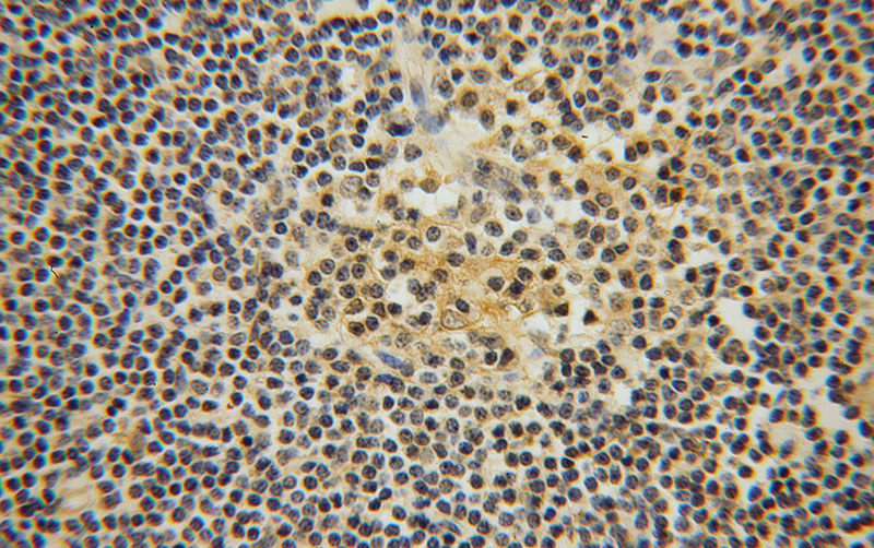 Immunohistochemical of paraffin-embedded human lymphoma using Catalog No:111952(ITM2A antibody) at dilution of 1:50 (under 40x lens)