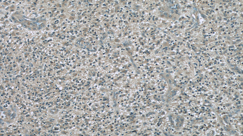 Immunohistochemistry of paraffin-embedded human gliomas slide using Catalog No:107243(dynactin-2 Antibody) at dilution of 1:50