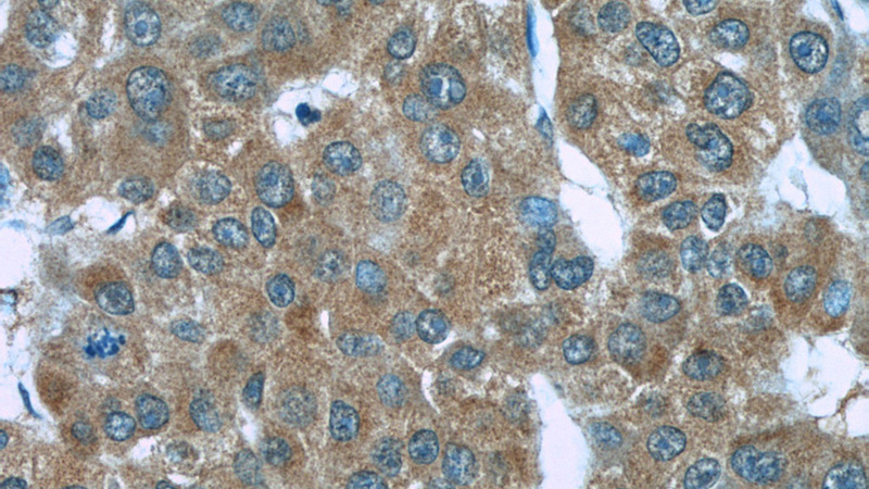 Immunohistochemistry of paraffin-embedded human liver cancer slide using Catalog No:107519(S100A6 Antibody) at dilution of 1:50
