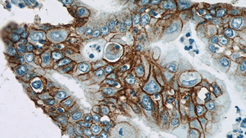 Immunohistochemical of paraffin-embedded human pancreas cancer using Catalog No:111864(ITGB4 antibody) at dilution of 1:100 (under 40x lens)