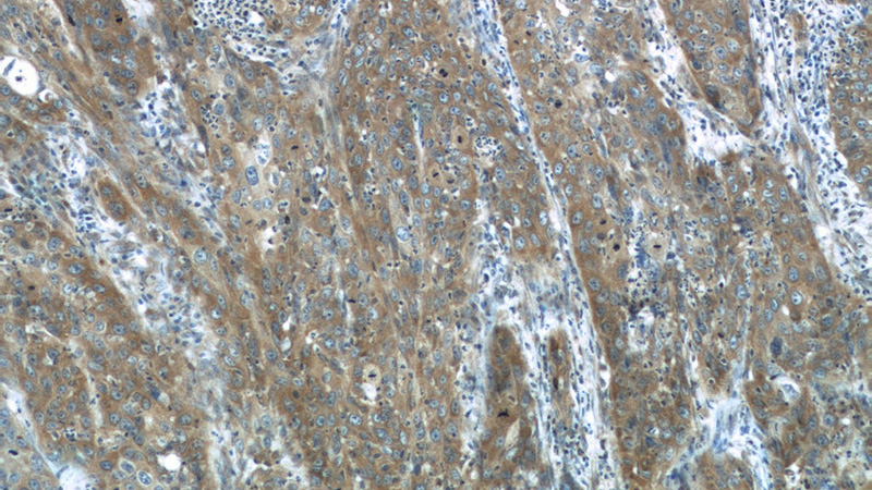 Immunohistochemistry of paraffin-embedded human cervical cancer tissue slide using Catalog No:112696(MMP1 Antibody) at dilution of 1:200 (under 10x lens)