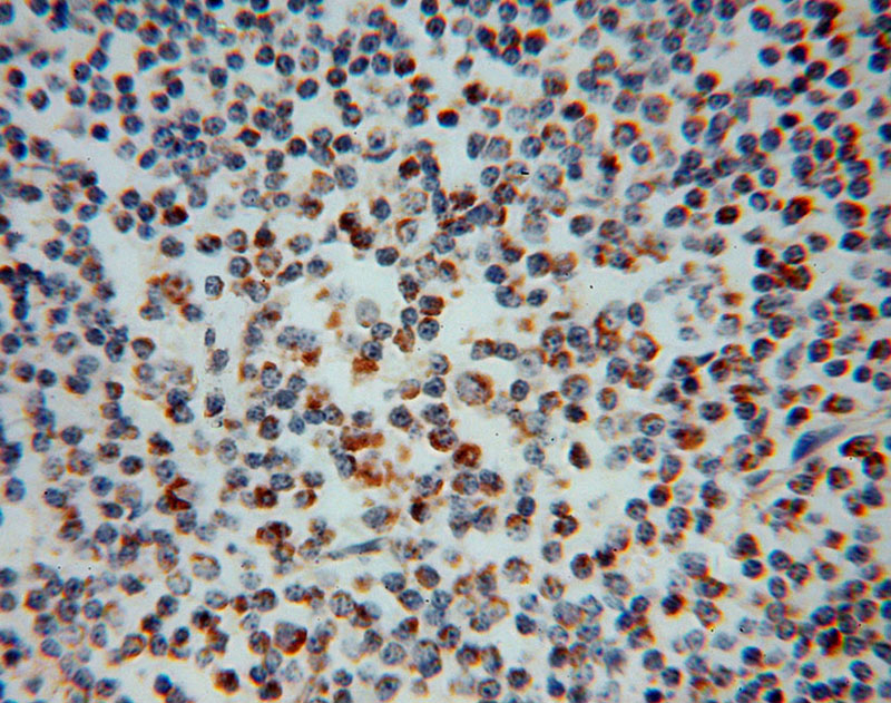 Immunohistochemical of paraffin-embedded human lymphoma using Catalog No:112826(MRPL37 antibody) at dilution of 1:50 (under 40x lens)