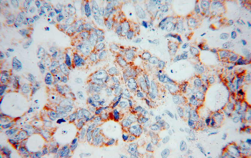Immunohistochemical of paraffin-embedded human liver cancer using Catalog No:109472(COQ7 antibody) at dilution of 1:100 (under 40x lens)