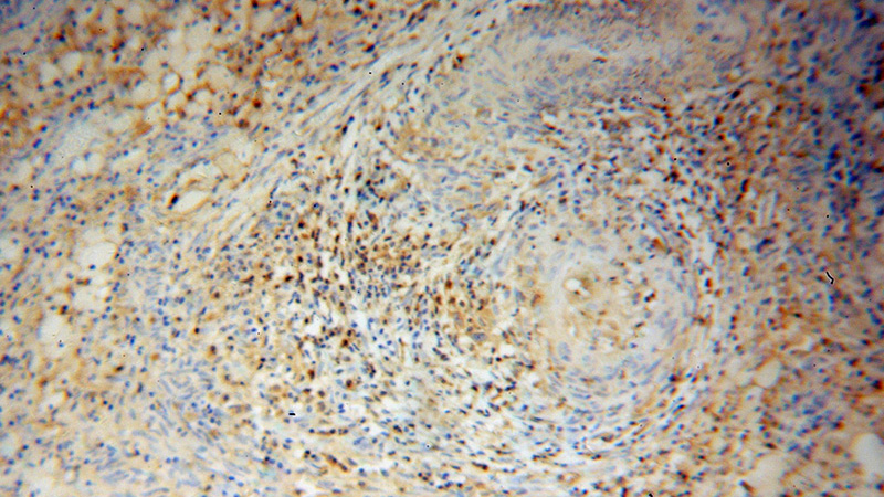 Immunohistochemical of paraffin-embedded human cervical cancer using Catalog No:109365(CFL1 antibody) at dilution of 1:50 (under 10x lens)