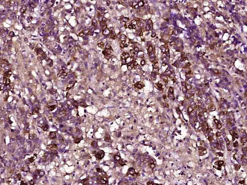 Fig8: Paraformaldehyde-fixed, paraffin embedded (Human colon carcinoma); Antigen retrieval by boiling in sodium citrate buffer (pH6.0) for 15min; Block endogenous peroxidase by 3% hydrogen peroxide for 20 minutes; Blocking buffer (normal goat serum) at 37