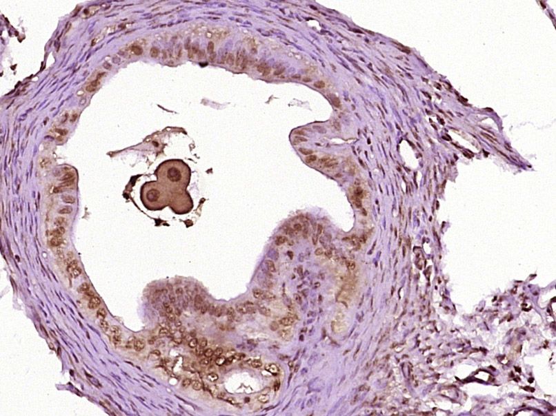 Fig2: Paraformaldehyde-fixed, paraffin embedded (Mouse ovarian); Antigen retrieval by boiling in sodium citrate buffer (pH6.0) for 15min; Block endogenous peroxidase by 3% hydrogen peroxide for 20 minutes; Blocking buffer (normal goat serum) at 37℃ for 30min; Antibody incubation with (Nanog) Polyclonal Antibody, Unconjugated at 1:400 overnight at 4℃, followed by operating according to SP Kit(Rabbit) (sp-0023) instructionsand DAB staining.