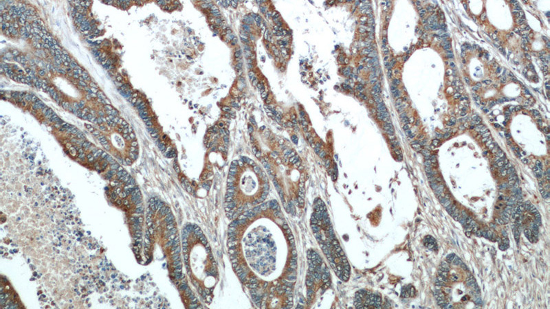 Immunohistochemical of paraffin-embedded human colon cancer using Catalog No:112119(KRAS antibody) at dilution of 1:50 (under 10x lens)